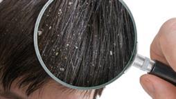dandruff or dry scalp